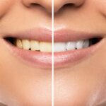 Teeth Whitening Merrillville